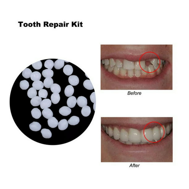 Pegamento para dientes sólidos, gránulos para reparación de dientes,  bricolaje, dientes postizos Abanopi Cola de dientes