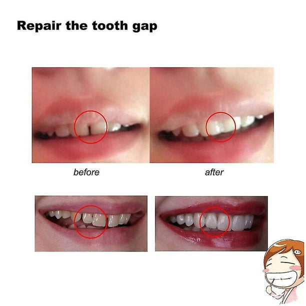 Pegamento sólido para dentadura postiza de resina, juego de reparación  temporal de dientes y huecos, dentadura postiza, pegamento sólido, adhesivo  para dentadura, dentista, 100g YONGSHENG 8390606400451