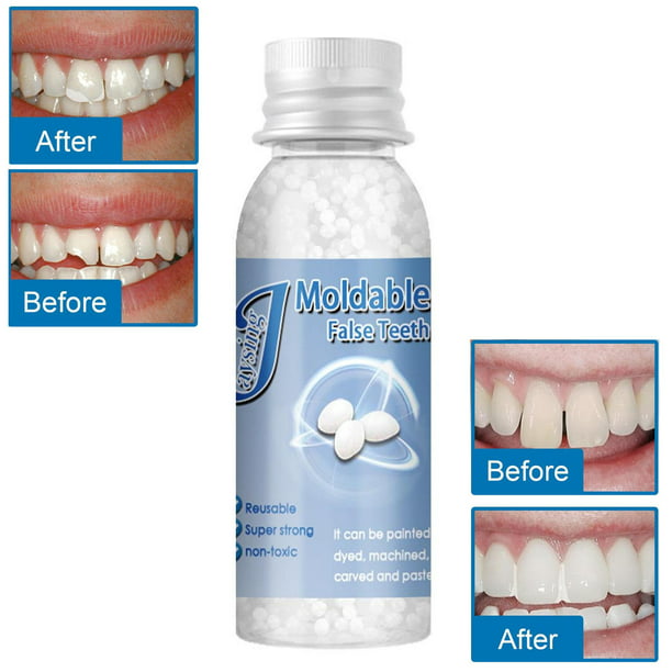 Kit de reparación temporal de dientes, dentadura postiza, pegamento sólido  para dentadura postiza, dientes rotos faltantes, moldeable, 1 ud.