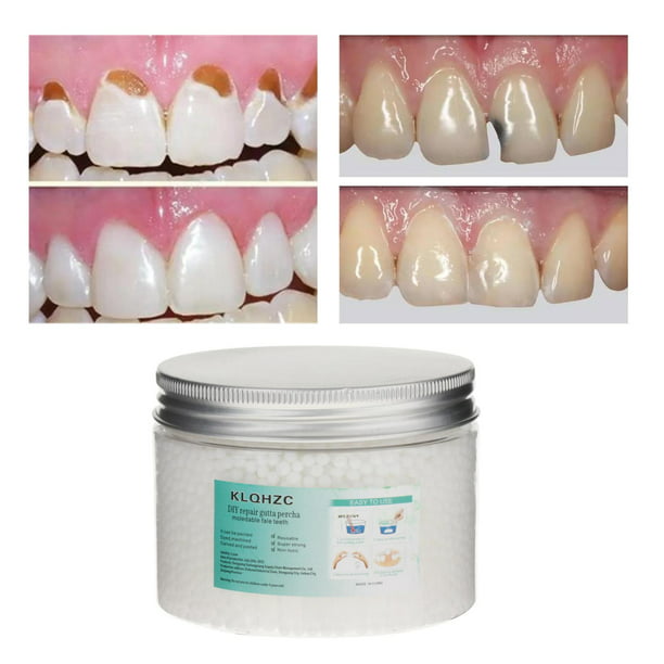 Kit de reparación temporal de dentadura postiza, relleno de dientes  moldeable, pegamento sólido para dentadura postiza (hy)