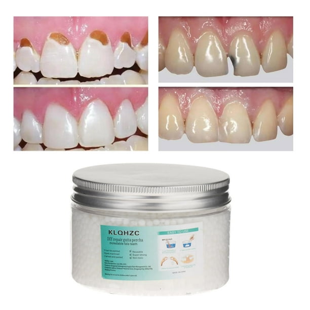 Gránulos moldeables de reparación dental de dientes postizos, kit de  reparación de dientes, perlas de reparación dental temporal de bricolaje