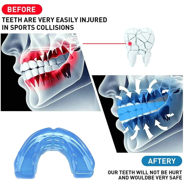 Tiranetes Ortodoncia Dental Anti Bruxismo para Dormir y Protector Bucal por  Ndcxsfigh