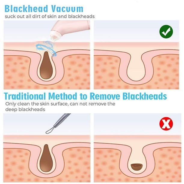 Aspiradora de poros para eliminar puntos negros, limpiador eléctrico de  poros faciales, acné, grasa, comedones y extractor de puntos blancos para