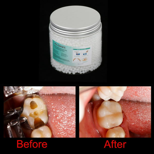 perlas de reparación de dientes, de reparación de empastes dentales dientes  postizos moldeables 25g,perlas de ajuste térmico instantáneo de relleno  temporal, de reparación de Yuyangstore perlas de reparación de dientes