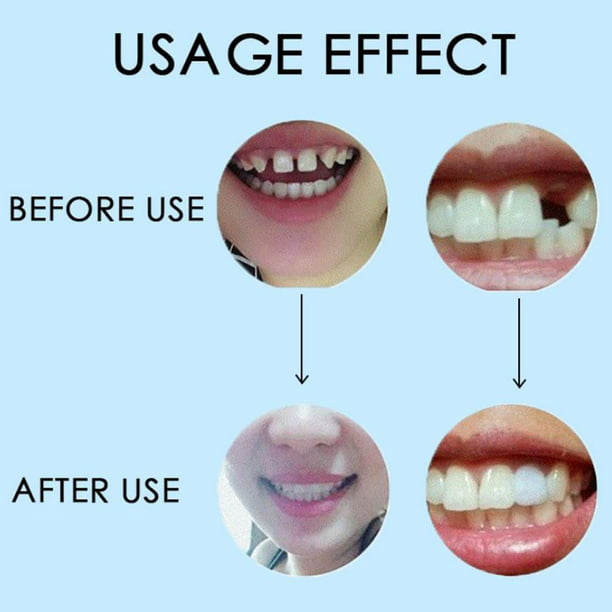 Pegamento dental de 10/100g pegamento temporal sólido para dentadura postiza  herramienta de belleza dental para adultos Unisex