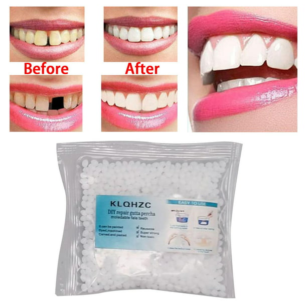 perlas de reparación de dientes, de reparación de empastes dentales dientes  postizos moldeables 25g,perlas de ajuste térmico instantáneo de relleno  temporal, de reparación de Yuyangstore perlas de reparación de dientes