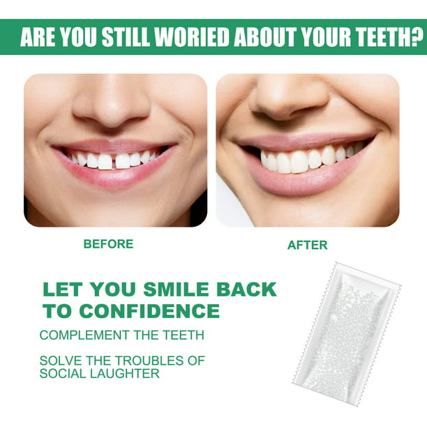 Pegamento sólido para dientes de 15g, gránulos blancos, complemento para  dientes, dentadura postiza multifuncional, pegamento sólido para recuperar  la sonrisa